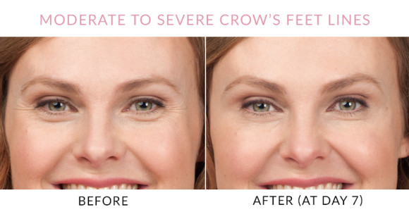 Gainesville, FL Botox® Treatments