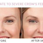 Gainesville, FL Botox® Treatments