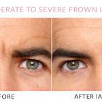 Gainesville, FL Botox® Treatments