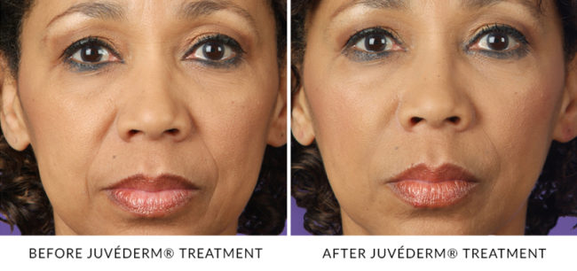 JUVÉDERM® Treatments in Gainesville, FL