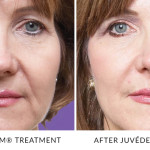 JUVÉDERM® Treatments in Gainesville, FL