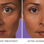 JUVÉDERM® Treatments in Gainesville, FL