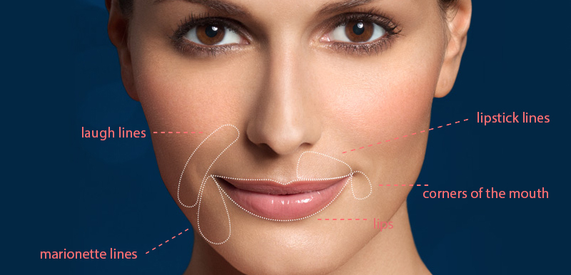 Restylane® Silk for Wrinkles and Lines around the Mouth.