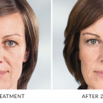 Correct shallow to deep facial wrinkles and folds in Gainesville, FL