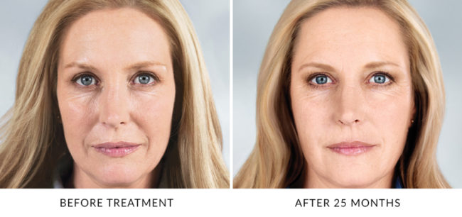 Sculptra Aesthetic is a new type of facial injectable made from poly-L-lactic acid, which helps to replace lost collagen.