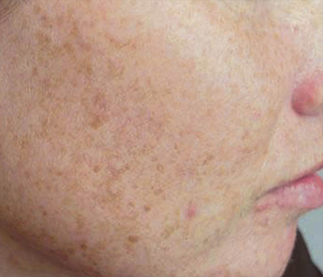 Skin Revitalization Before Photo