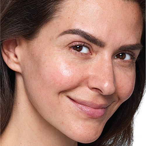 SKINVIVE - Unique HA Microdroplet for Cheek Smoothness - After