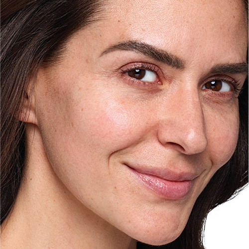 SKINVIVE - Unique HA Microdroplet for Cheek Smoothness - Before