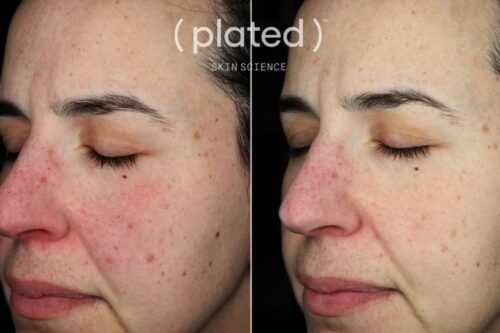 Real Results with ( plated )™ Skin Science - Before and After